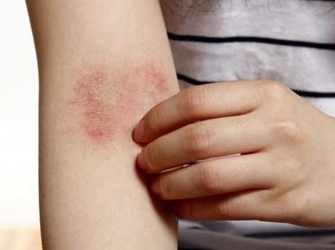  대상포진초기증상 5가지 신호와 예방법 알기