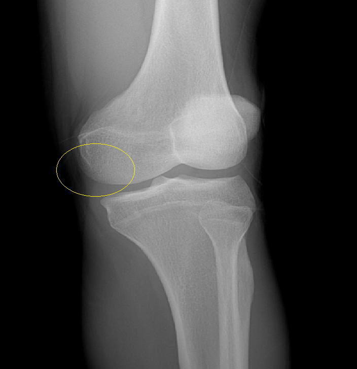 Ankle Stress view, Knee AP and OBL