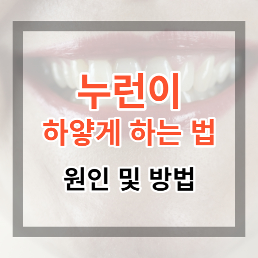  누런이 하얗게 하는 방법 및 원인으로 치아를 하얗게 관리해 보세요.