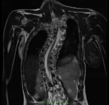 척추측만증 MRI 촬영