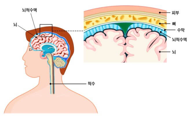 뇌수막염 증상