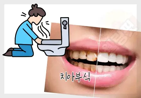 먹토로-인한-치아부식