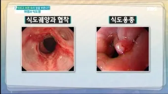 역류성 식도염 원인 초기증상 예방하는 방법_13