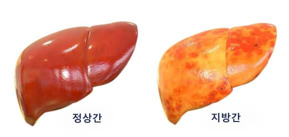  지방간에 좋은 음식 5가지 및 없애는 방법