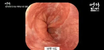 역류성 식도염 원인 초기증상 예방하는 방법_9