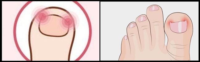  내성발톱 자가치료 조심하세요