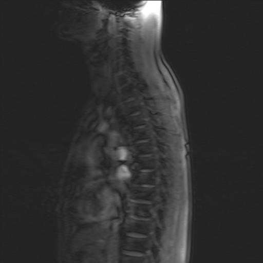  t-spine sagital scan