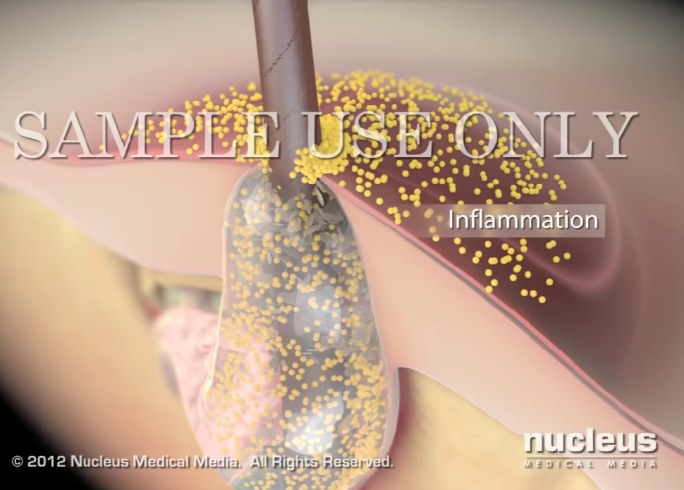 등드름 가드름 쉽게 없애는 법 4