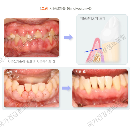 치은절제술