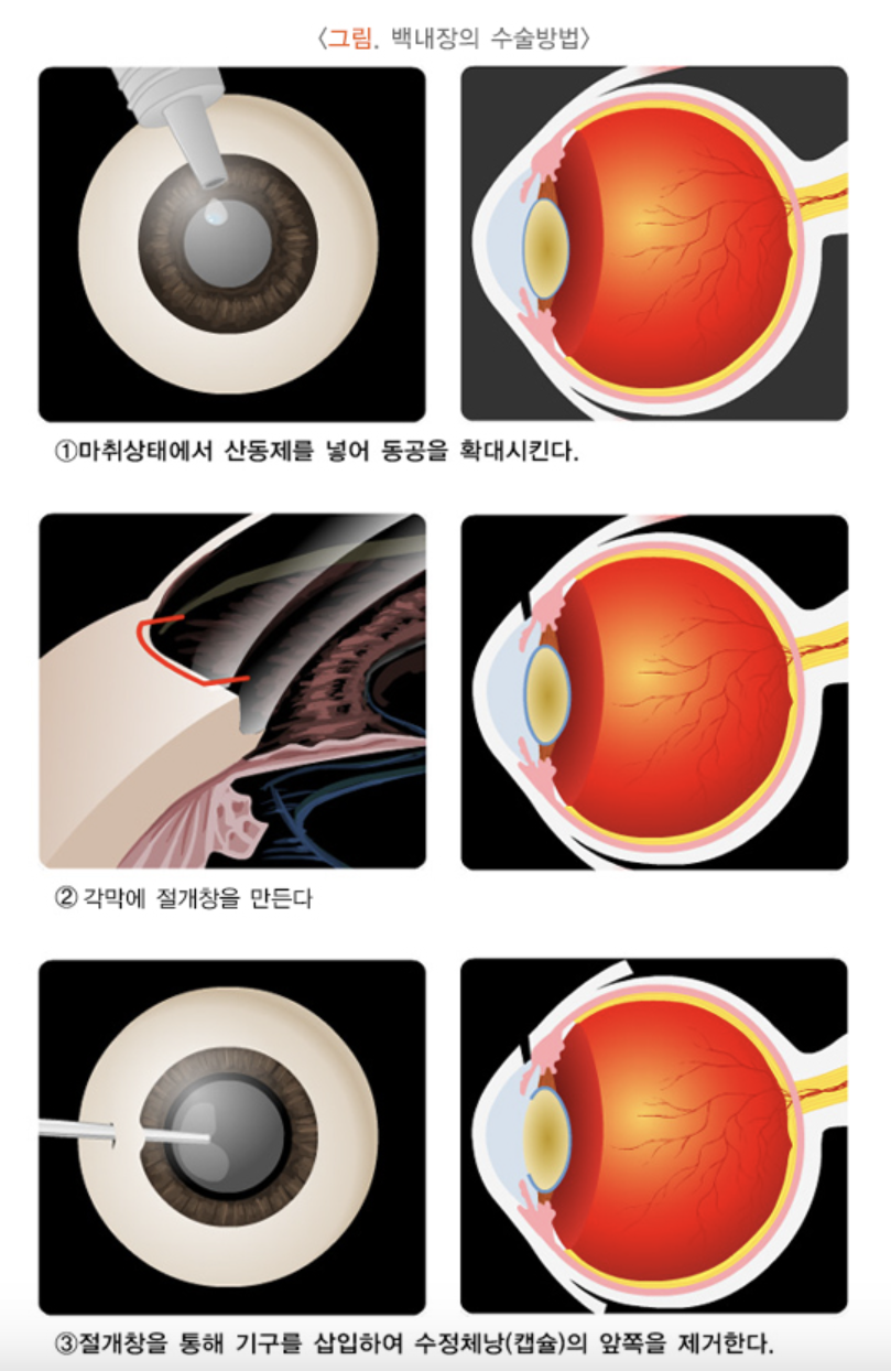 백내장 수술방법