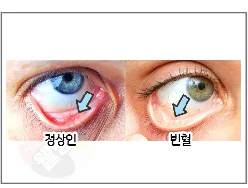 빈혈이-있으면-눈-아래쪽에-혈색이-창백합니다.