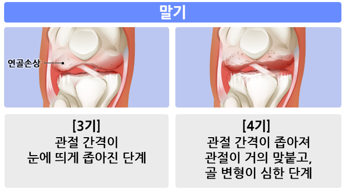 무릎관절염