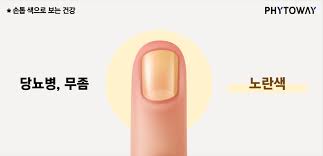 손톱으로 보는 건강상태