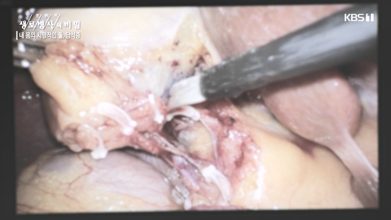 생로병사의 비밀.E886.231019p-NEXT.mp4_20231019_203449.581.jpg
