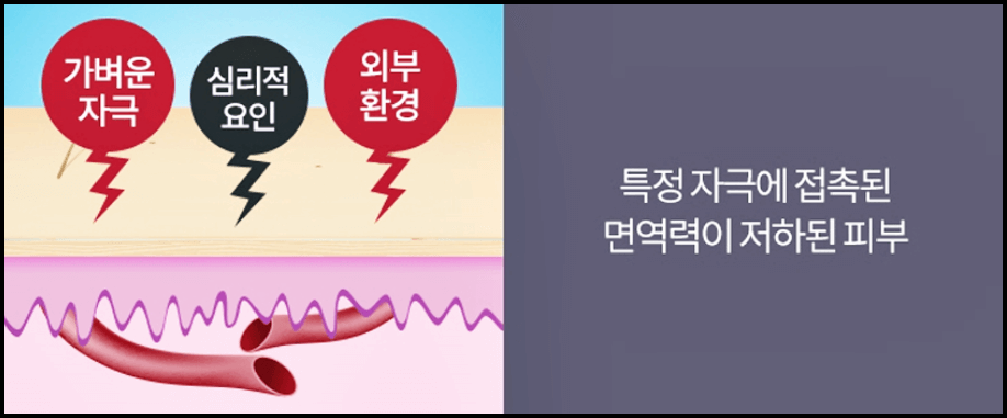 두드러기 원인