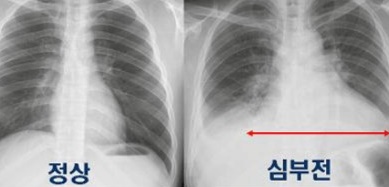  심부전 원인 및 증상 치료방법, 심장질환 합병증 입니다.