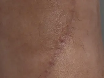 흉터전용 치료 추천 스카덤 겔 효능효과_17