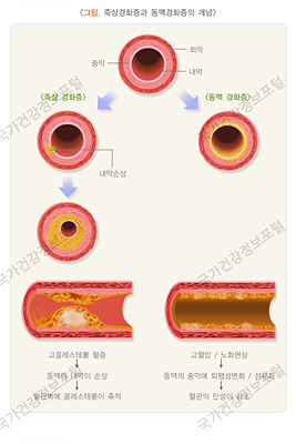 죽상경화증의 개념