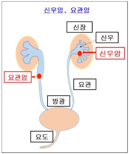 신우암 요관암