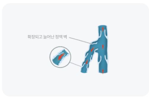 센시아-정맥순환장애-증상-개선제