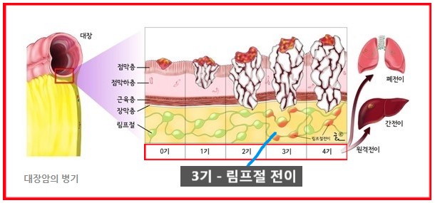  메리츠표적항암치료 - 일반코스, vip코스