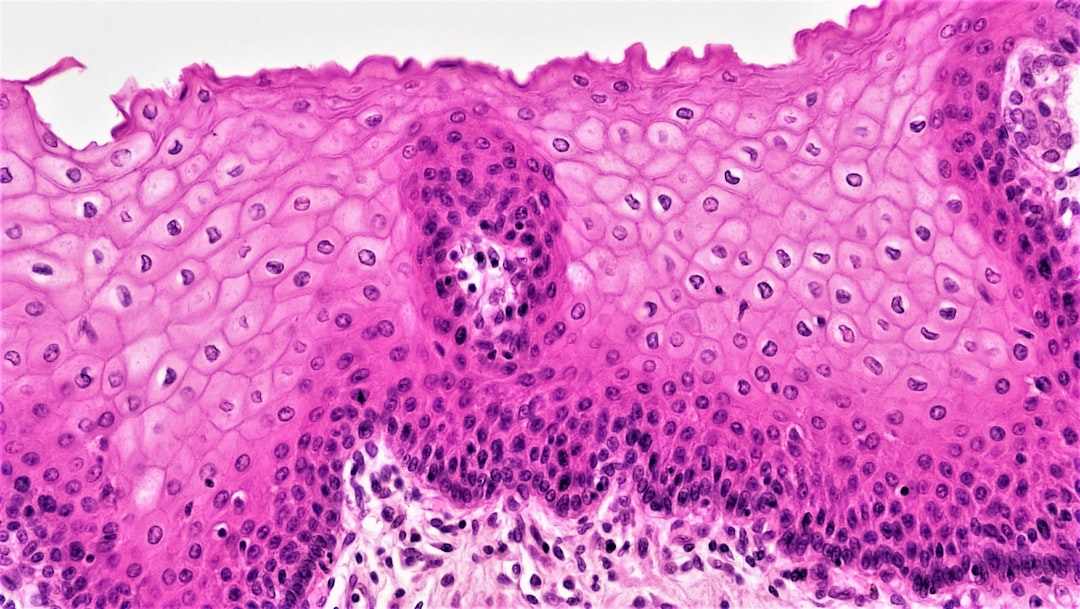 Squamous carcinoma