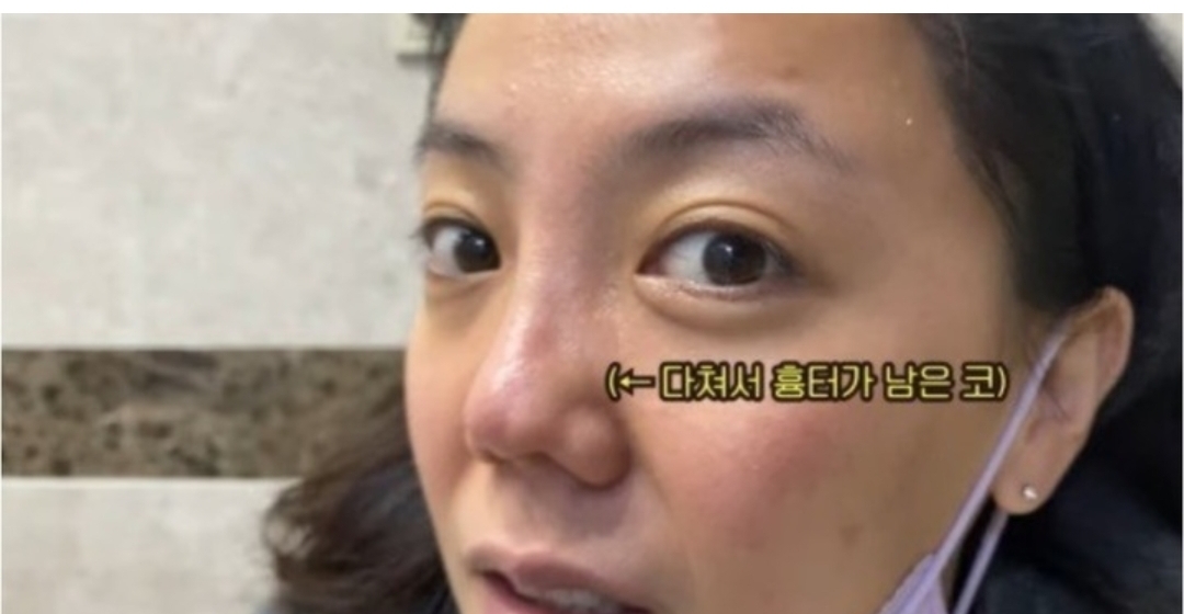  고은아 코 흉터 고민