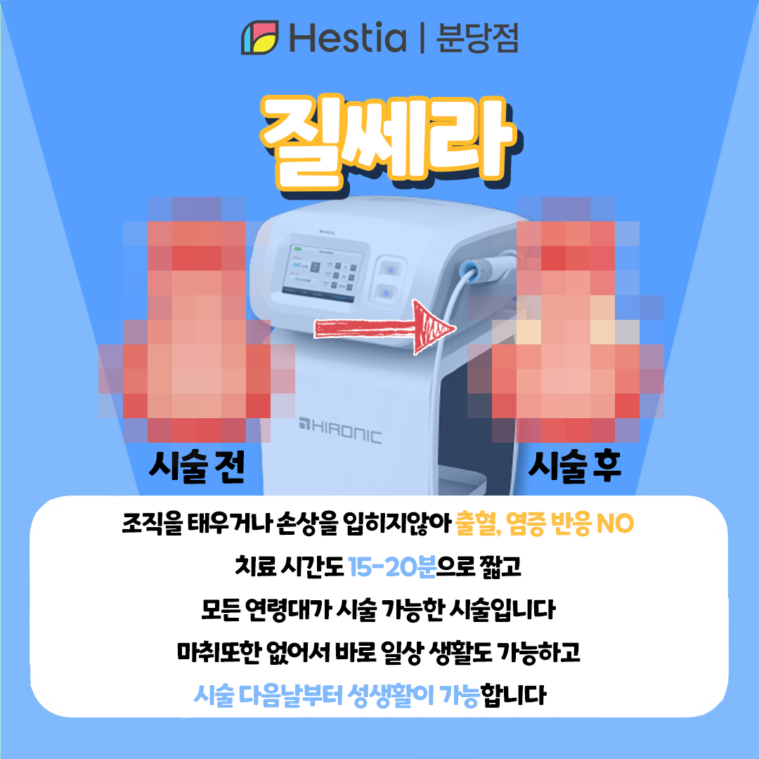 여성 불감증 늘어난 질 질쎄라를 이용한 질이완개선