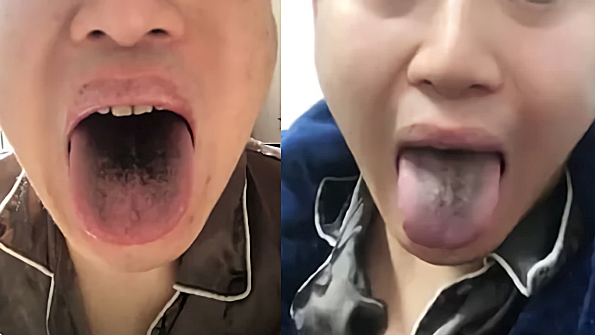  중국 변종 코로나 확산 우려, 얼굴 혀 검게 변하고 눈 퉁퉁부어