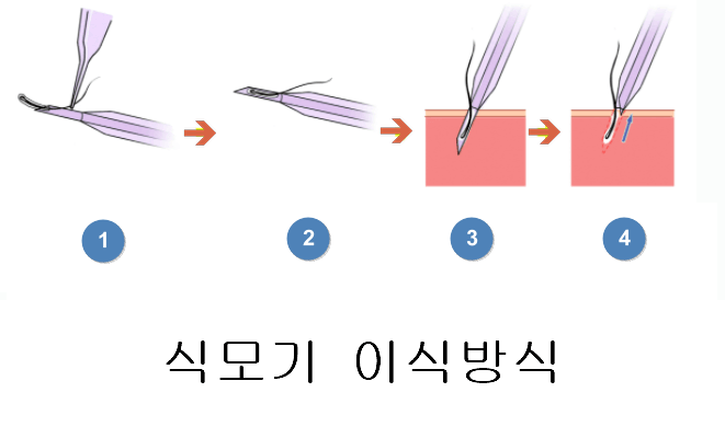 비절개 모발이식 식모기 방식 순서