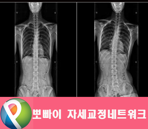 부천 척추측만증 휘어지는 척추 빠른 교정 필요