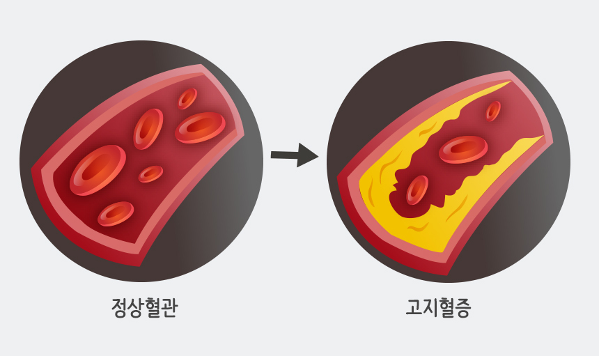  고지혈증 원인 증상 치료 부작용 관리방법