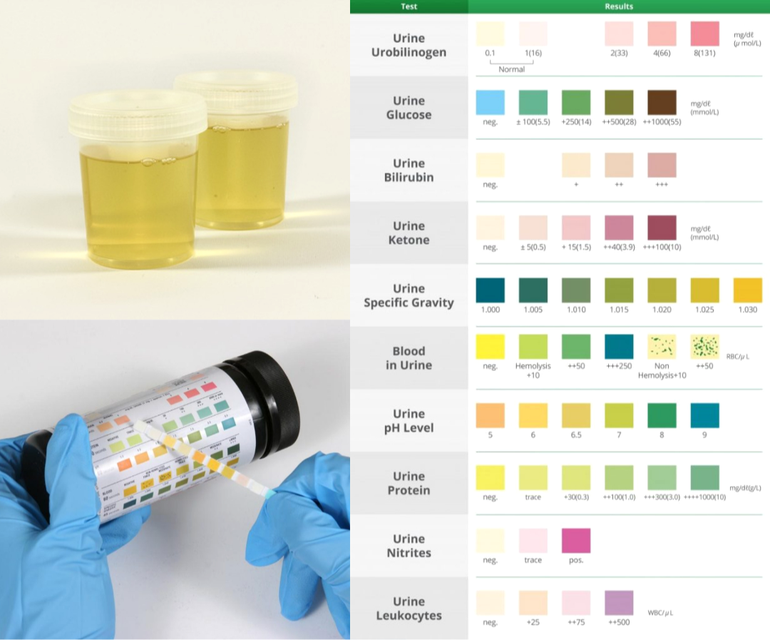 urine analysis and urine dipstick test