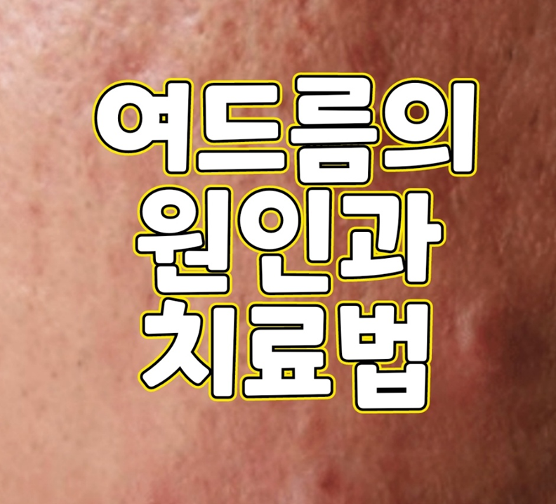  여드름의 원인과 치료법