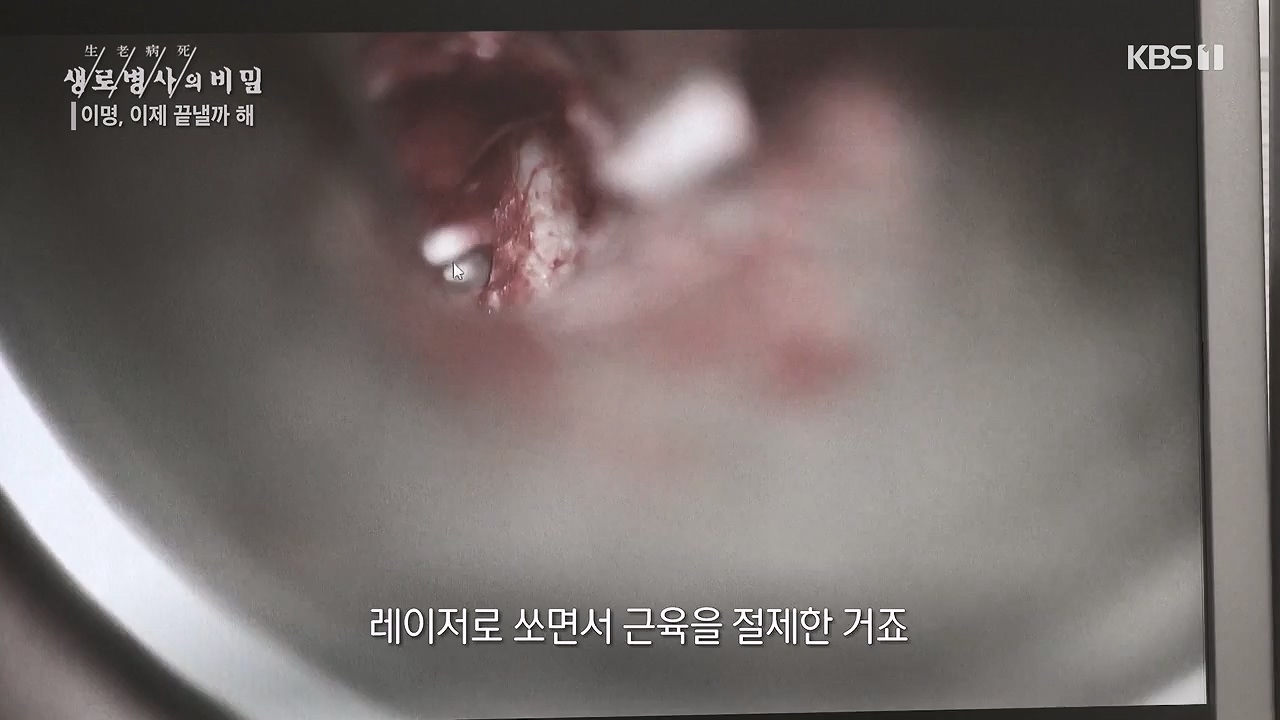 생로병사의 비밀.E883.230914p-NEXT.mp4_20230914_204620.586.jpg