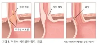 역류성 식도염 원인 초기증상 예방하는 방법_8