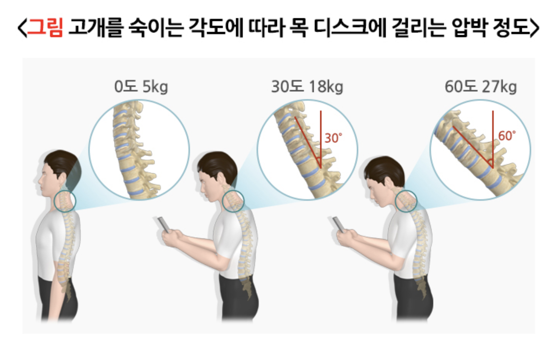 목 디스크에 걸리는 압박 정도