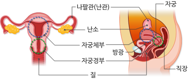 자궁근종