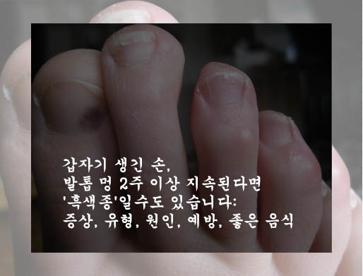 갑자기 생긴 손&#44; 발톱 멍 2주 이상 지속된다면 &#39;흑색종&#39;일수도 있습니다: 증상&#44; 유형&#44; 원인&#44; 예방&#44; 좋은 음식