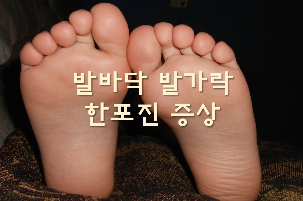  손이나 발바닥 발가락 한포진 초기증상