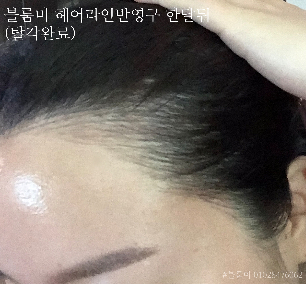 미헤어라인 이미지