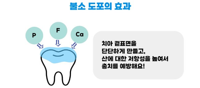 불소도포