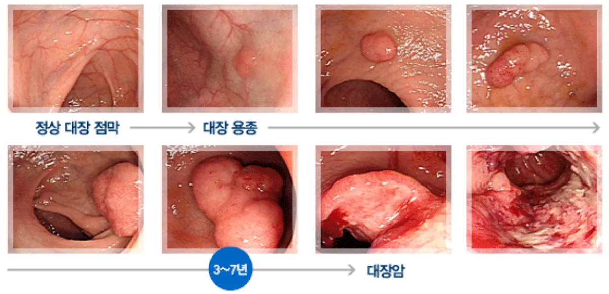 변비가 대장암으로 가는 과정