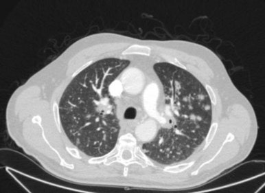 sarcoidosis의 chest CT 소견