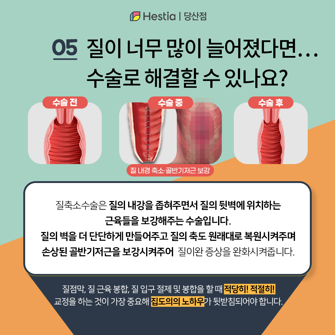 질벽 주름 감소, 질돌출 심하면 수술해야하나요?