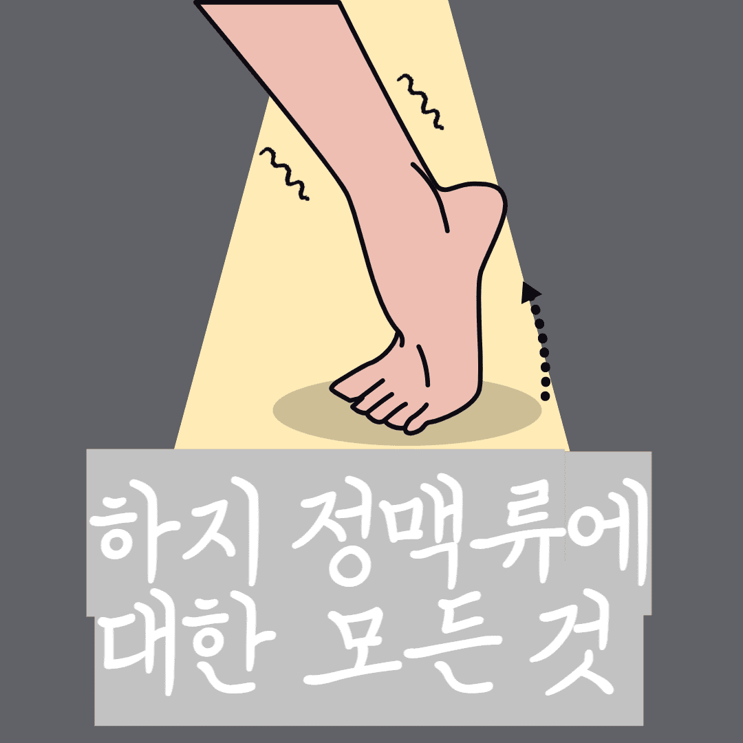 하지정맥류에 대한 모든것