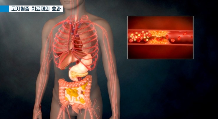 사람-장기와-막힌-혈관
