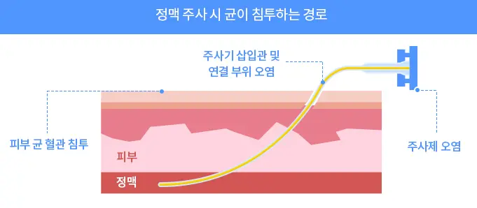 정맥주사-감염경로