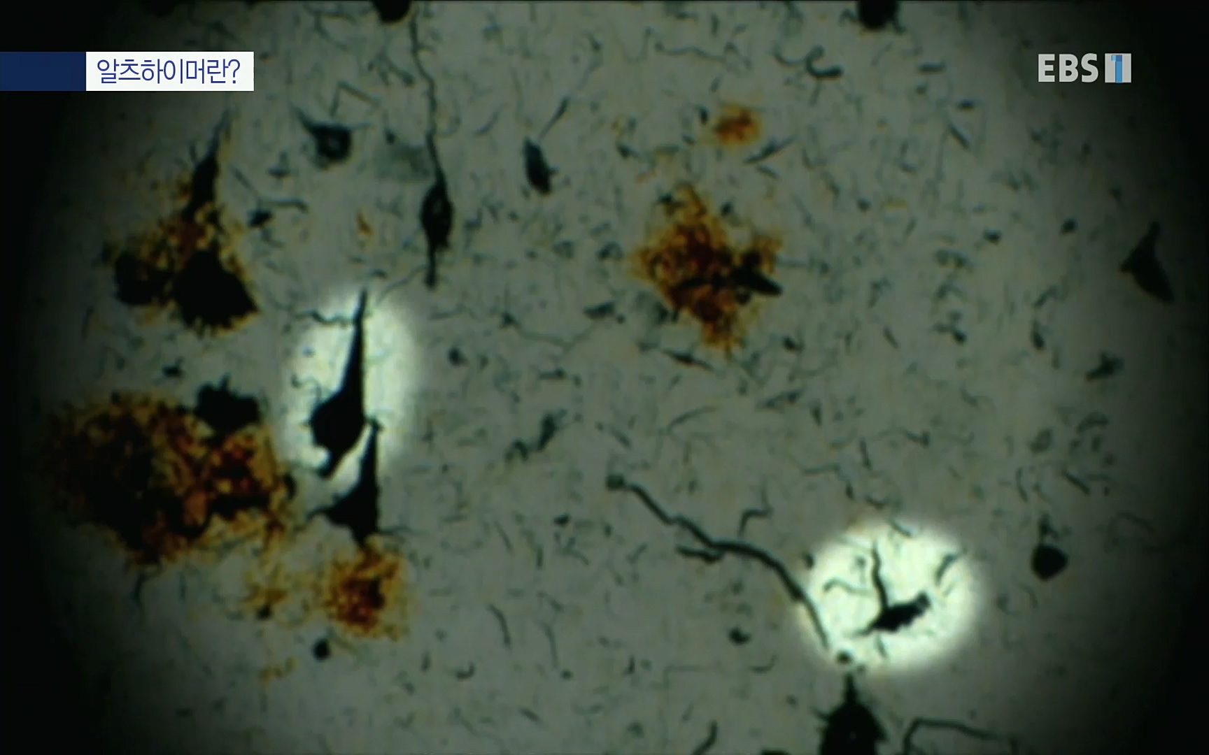 EBS 명의 헬스케어 - TV - 교육의 중심 EBS명의 15년 치매 치료의 패러다임이 바뀐다.mp4_20220808_211003.385.jpg