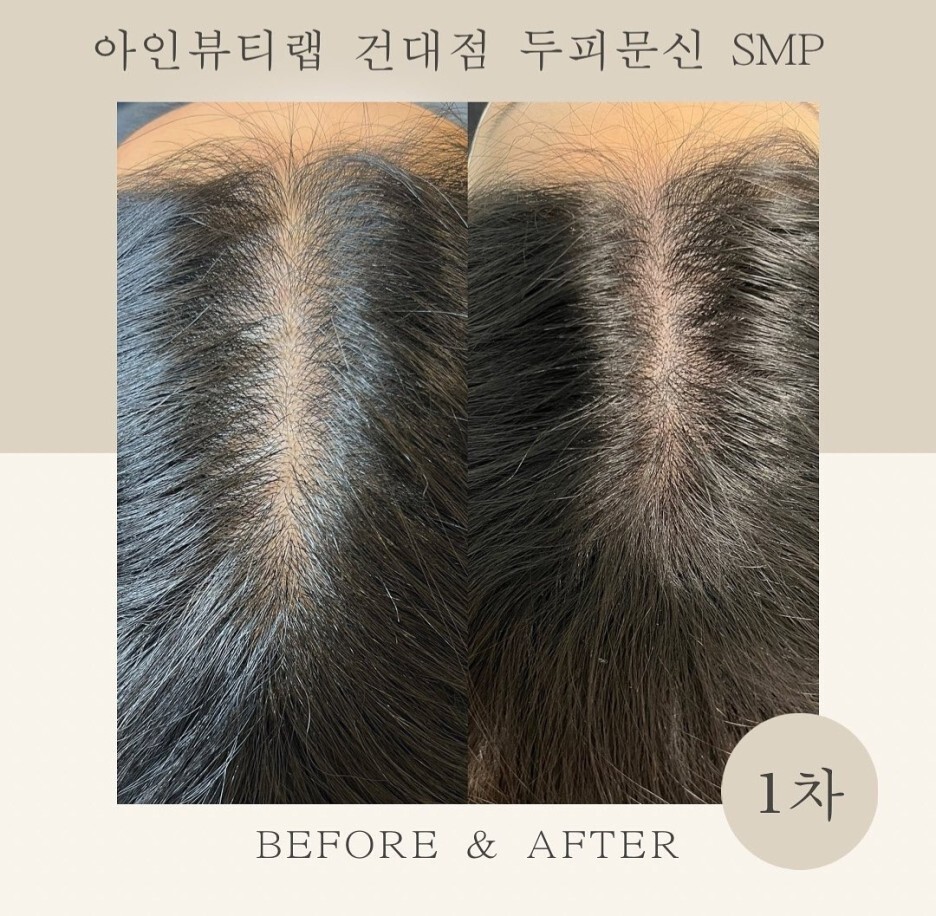  건대두피문신 1차 시술만 했는데 이정도라고? 건대입구두피문신 아인뷰티랩건대점